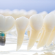 Illustration for article titled Longevity of Dental Implantsem/em